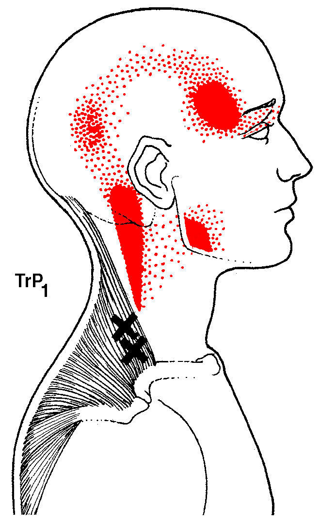 Gallina Acupuncture | Dry Needling | Santa Barbara, CA
